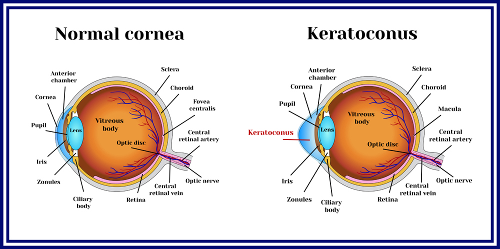 Normal Eye vs Keratoconus